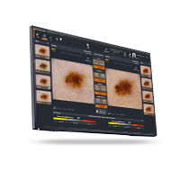 Dermatoscopia en Chile